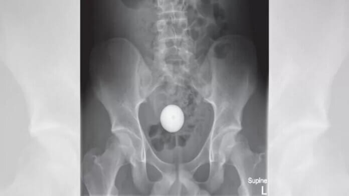 bola-no-anus